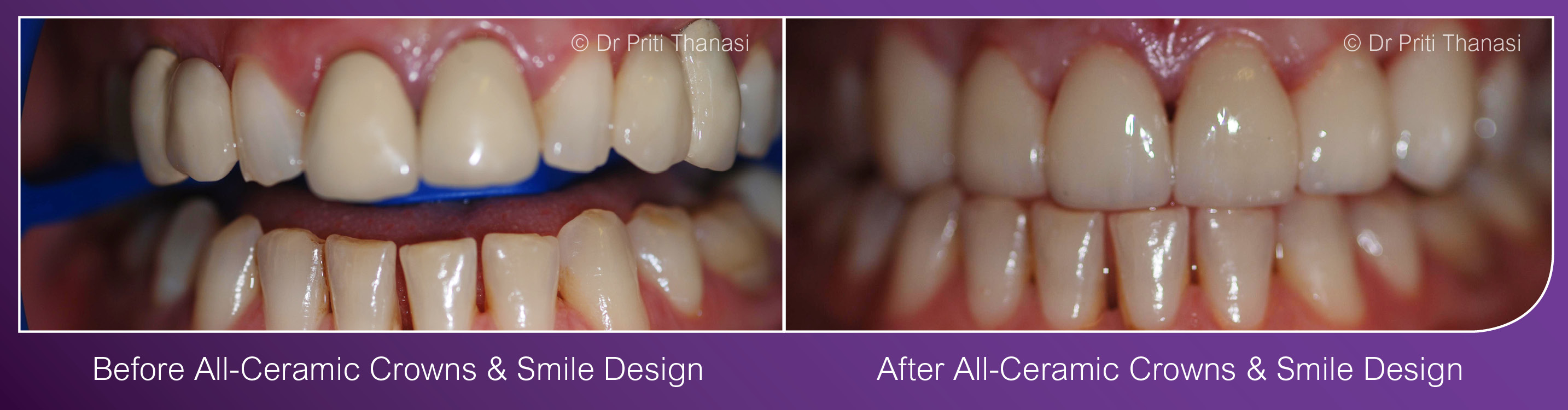 Smile Design Cosmetic Dentist Leicester